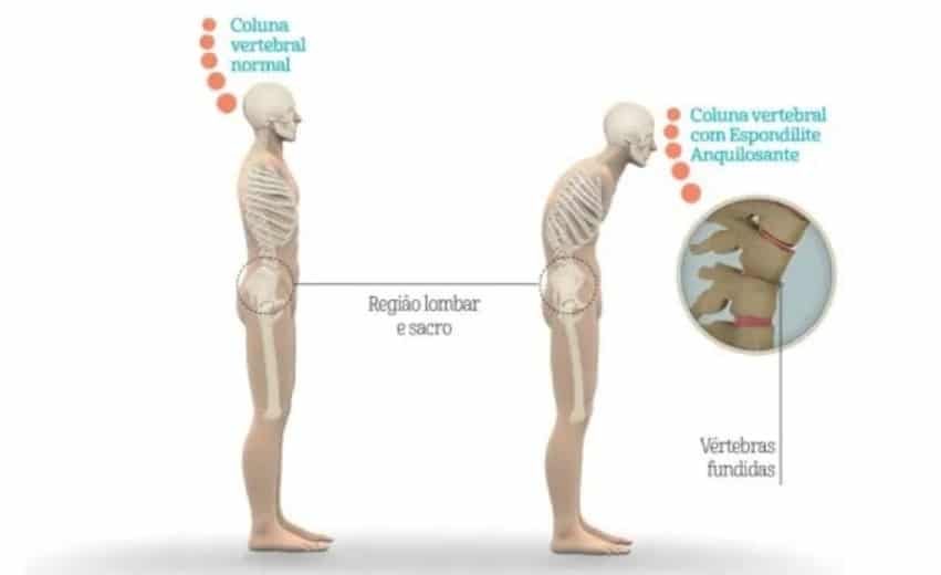 Imagem ilustrativa demostra a progressão da Espondilite Anquilosante na coluna vertebral. 