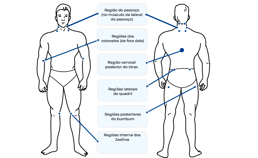 Ilustração de dois corpos masculinos, um de frente e outro de costas, com sinalizações de onde as dores da fibromialgia acontecem.